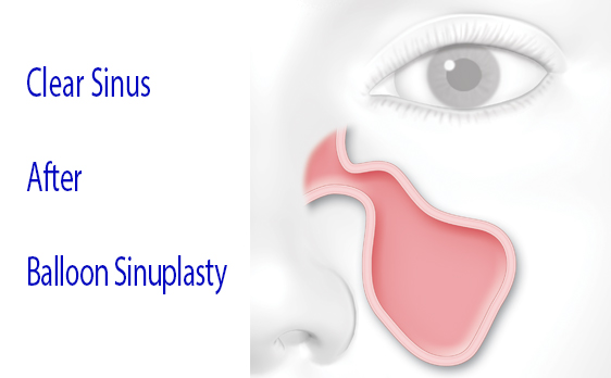 Graphic of clear sinus after balloon sinuplasty