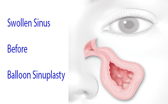 Graphic of swollen sinus